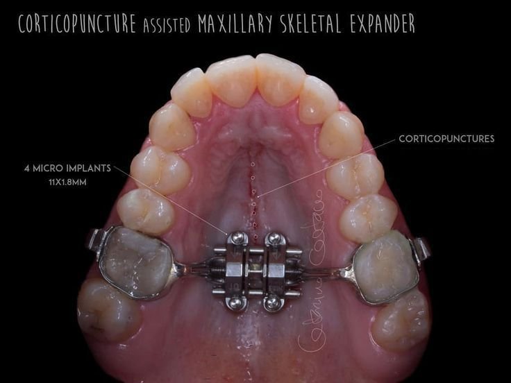 Arch expansion orthodontic treatment