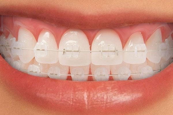 Ceramic braces for teeth alignment treatment