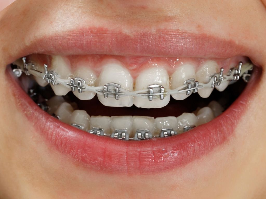Metal braces orthodontic treatment option