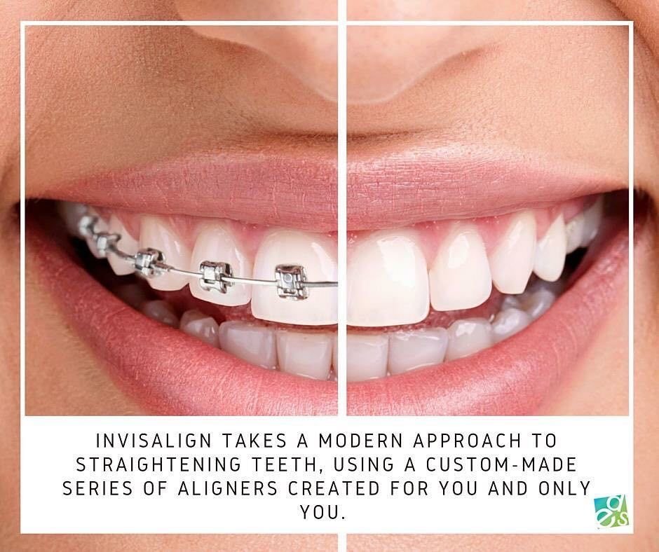 Comparison of metal and ceramic braces